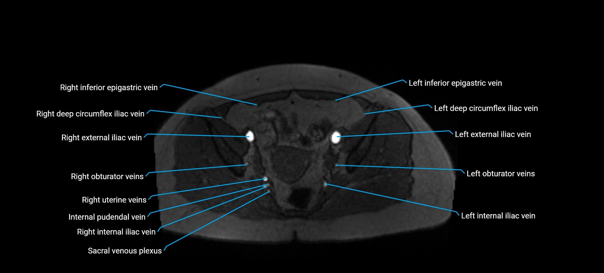 MRV abdomen pelvis & lower limb axial cross sectional anatomy labelled MRI image 159 (1).webp